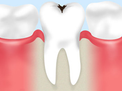 虫歯の原因、進行段階についてご存知ですか？