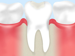 虫歯の原因、進行段階についてご存知ですか？