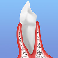 最近よく聞く「歯周病」ってどういう病気？